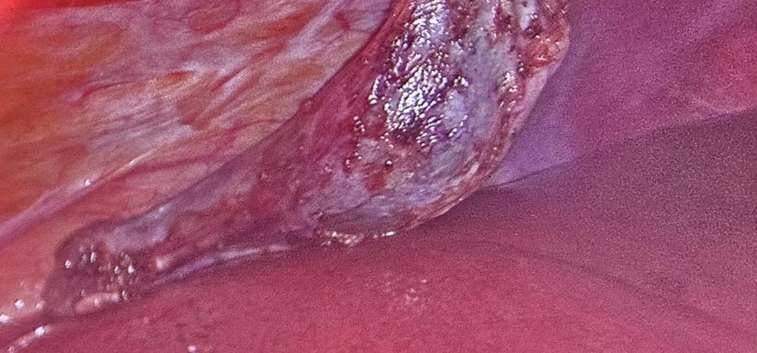 Magnified laparoscopic operative field