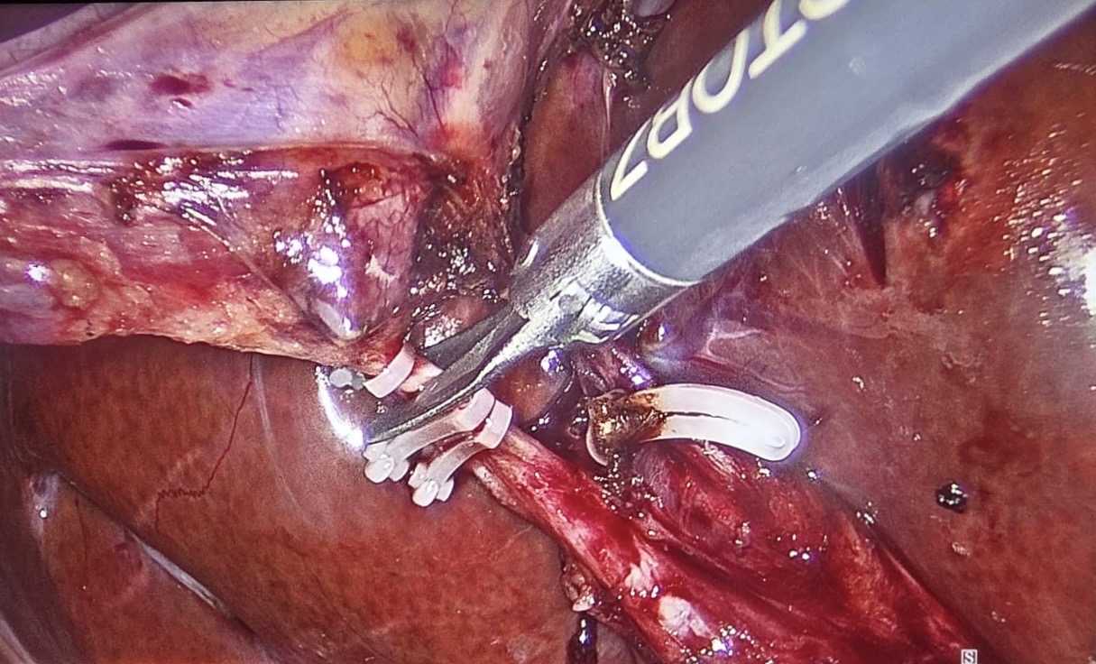 Robotic operative view during vessel control