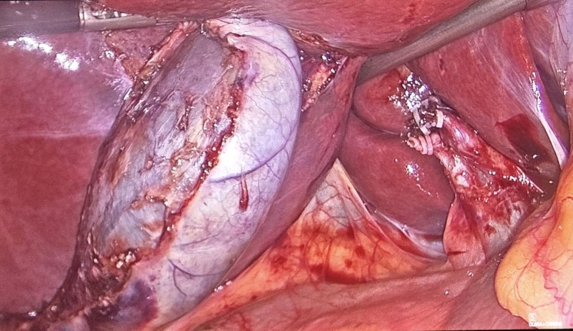 Robotic operative view of the surgical field