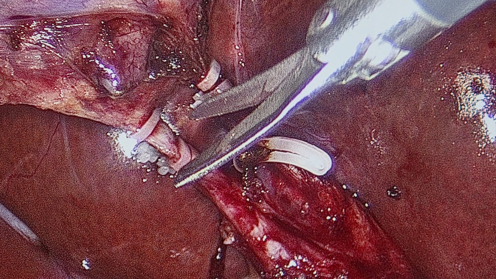 Robotic instrumentation during minimally invasive surgery